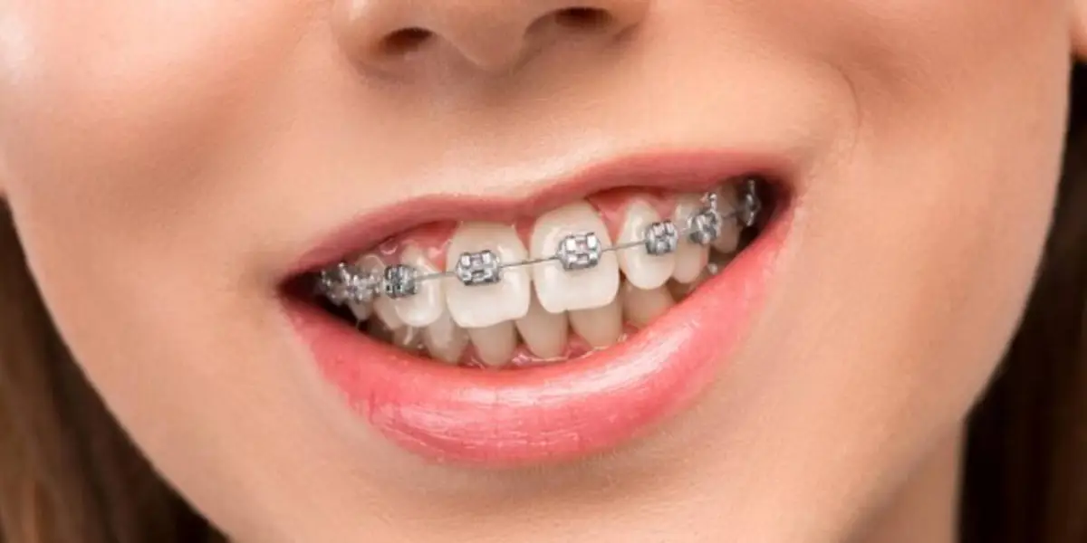 Braces Cost: Your Guide to Affordable Orthodontic Treatment Expenses