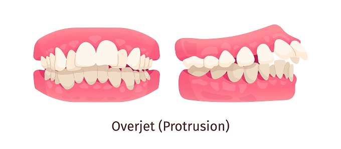 overjet